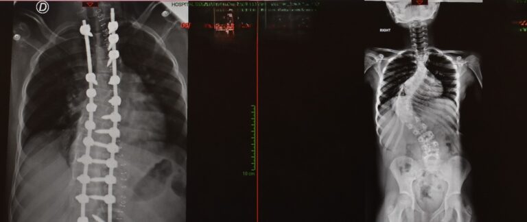 Junio: Mes de la concientización de la escoliosis