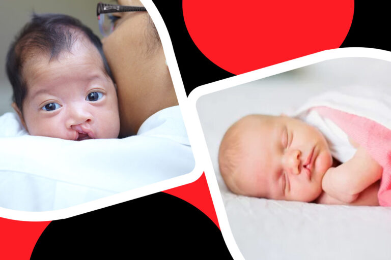 3 acciones de Corporativo Kosmos en beneficio de la niñez con labio y paladar hendido