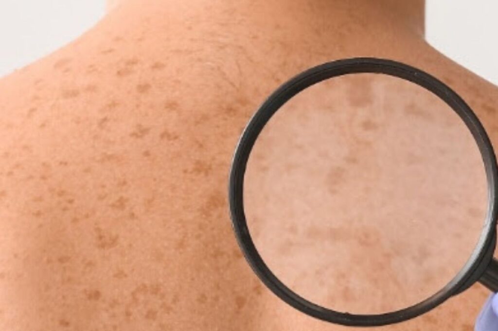 prevención vs melanoma